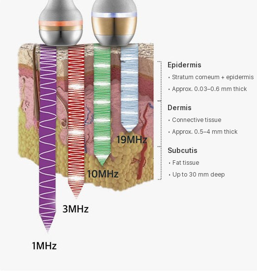Diagram showing 1 MHz, 3 MHz and 10 MHz ultrasound reaching different depths: the epidermis (stratum corneum and living epidermis, about 0.03–0.6 mm thick), the dermis (connective tissue, about 0.5–4 mm thick) and the subcutis (fatty tissue, up to 30 mm deep)