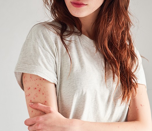 Woman with red eczema patches on the inner arm