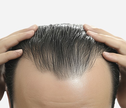 Male pattern hair loss with an M-shaped receding hairline at the temples