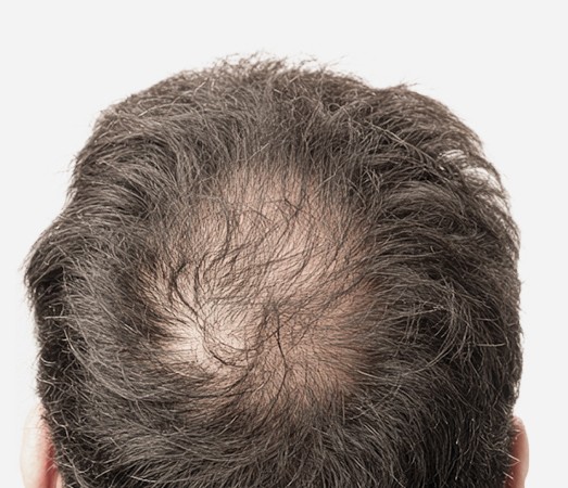 Alopecia areata with a bald patch on the crown