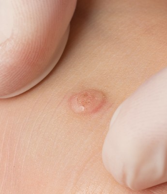 Round common wart on the skin between the fingers