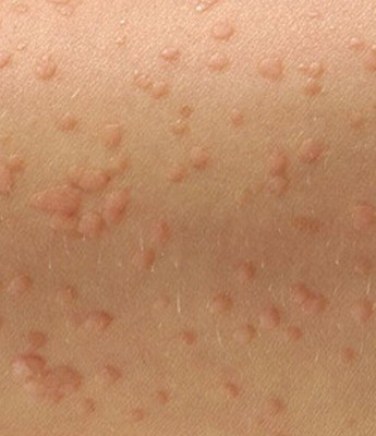 Several small, flat warts raised on the skin surface