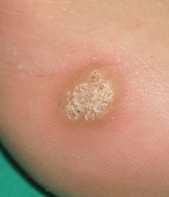 Plantar wart covered with thick skin on the sole of the foot