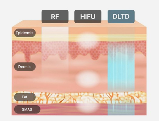 Diagram comparing how deep RF, HIFU and DLTD energy reaches the epidermis, dermis, fat layer and SMAS