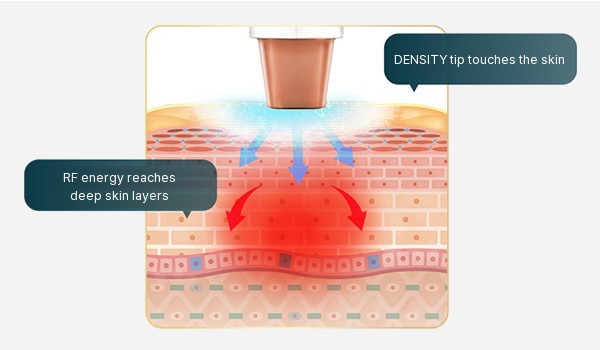Diagram of DENSITY RF energy working in the deep skin layers