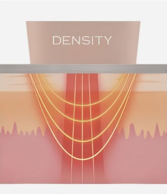 Diagram of DENSITY alternating monopolar and bipolar RF