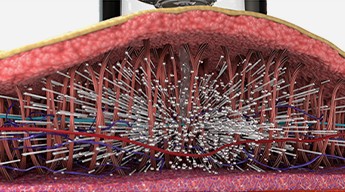 Cross-section showing collagen production beginning in the SMAS layer