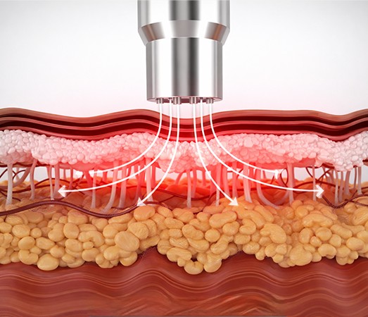 Conventional method: heat spreads horizontally across the skin surface