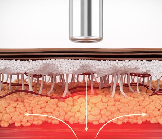 ERAVITY: heat delivered vertically into the deeper skin layers