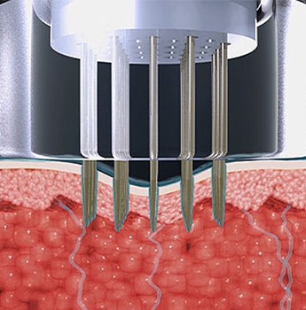 Diagram of a POTENZA needle tip touching the skin