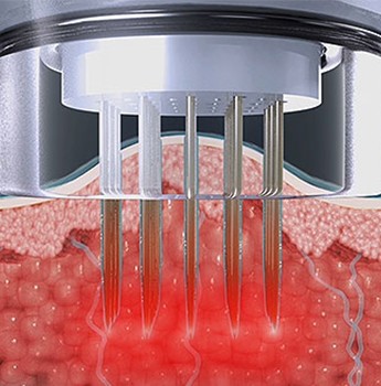 Diagram of RF energy released into the dermis through the needles