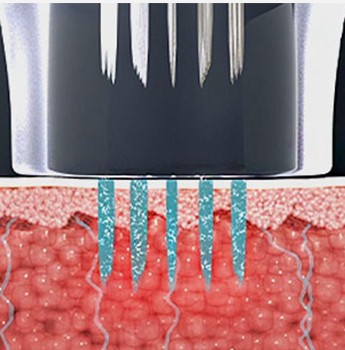 Diagram of coagulation zones formed where the needles entered