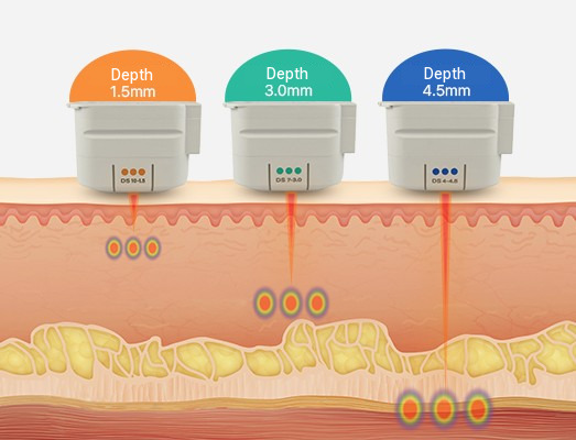 Diagram of the skin layers reached by ultrasound energy from the 1.5mm, 3.0mm and 4.5mm treatment-depth tips